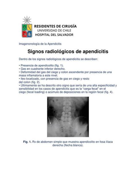 Signos Radiológicos De Apendicitis Biologista13 Udocz