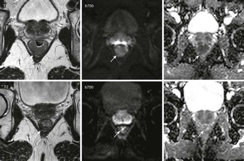 Diffusion Weighted Imaging Of The Abdomen Radiology Key