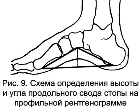 Продольное плоскостопие