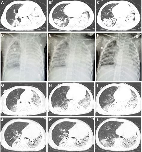 Imaging Of The Patients Chest Computed Tomographic Ct Scan Obtained