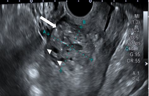 Gray Scale Transvaginal Ultrasound Image Showing A Heterogeneous Area