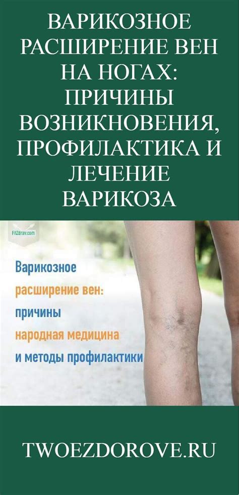 Варикозное расширение вен на ногах: причины возникновения, профилактика ...