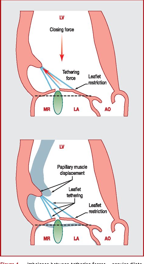 Figure 1 From Ischemic Mitral Regurgitation New Concepts Semantic