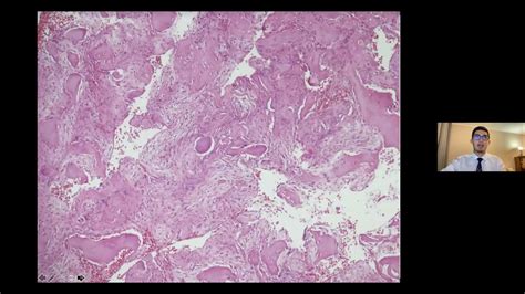 07 Cc Fibroma Osificante Central Mandibular Reporte De Caso Youtube