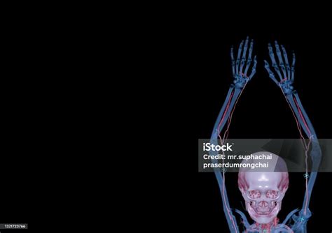 Cta Brachial Artery Or Ct Scan Of Upper Extremity Or The Arm 3d