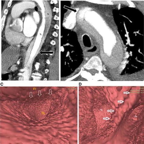 A Year Old Man With Stanford A Aortic Dissection A Sagittal Mdcta