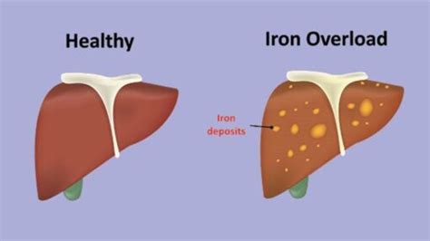 Hemochromatosis (iron overload) - Fekomi Herbals