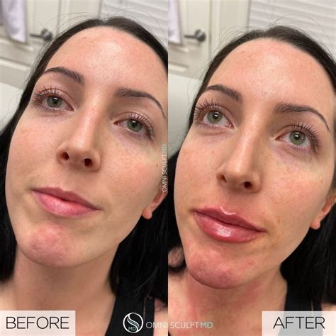 Lip Injection Before After Gallery OMNI SCULPT MD