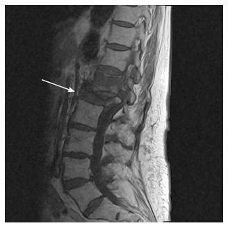 Pathological Fracture Spine