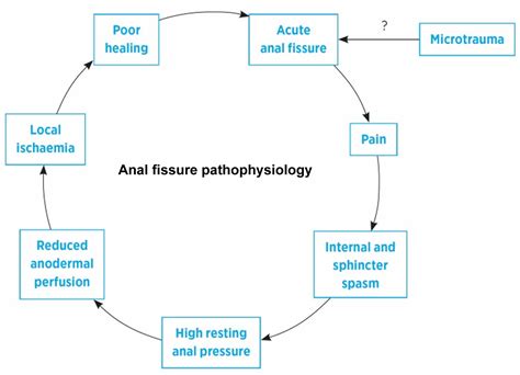 Anal Fissure Causes Signs Symptoms Diagnosis And Treatment