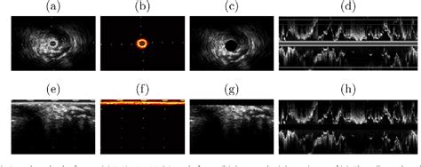 Figure 1 From Segmentation Of Arterial Walls In Intravascular Ultrasound Cross‐sectional Images