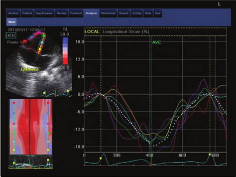 Obtaining Right Ventricle Global Longitudinal Strain Measures From The