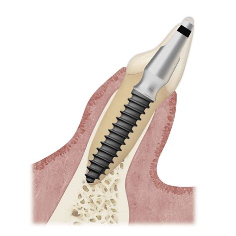 Implant Dentaire Cylindrique Ms Implant Surface Sa Osstem Implant