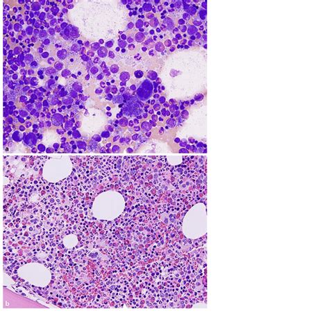 A Bone Marrow Aspirate Smear Showing Myeloid Hyperplasia B Bone Marrow Download Scientific