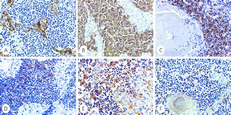 Immunohistochemical Features Of Synchronous Metastatic Cutaneous Download Scientific Diagram