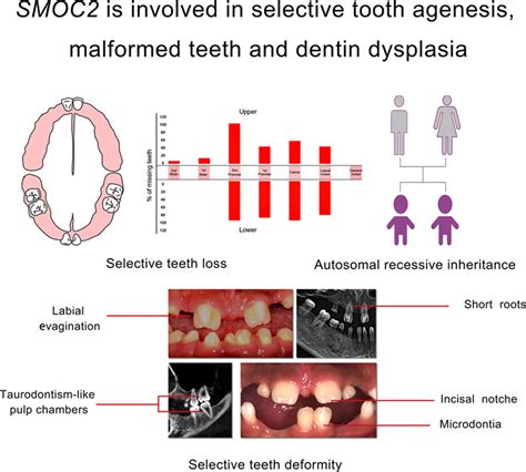 A New Smoc2 Mutation Within Selective Tooth Agenesis Malformed Teeth And Dentin Dysplasia