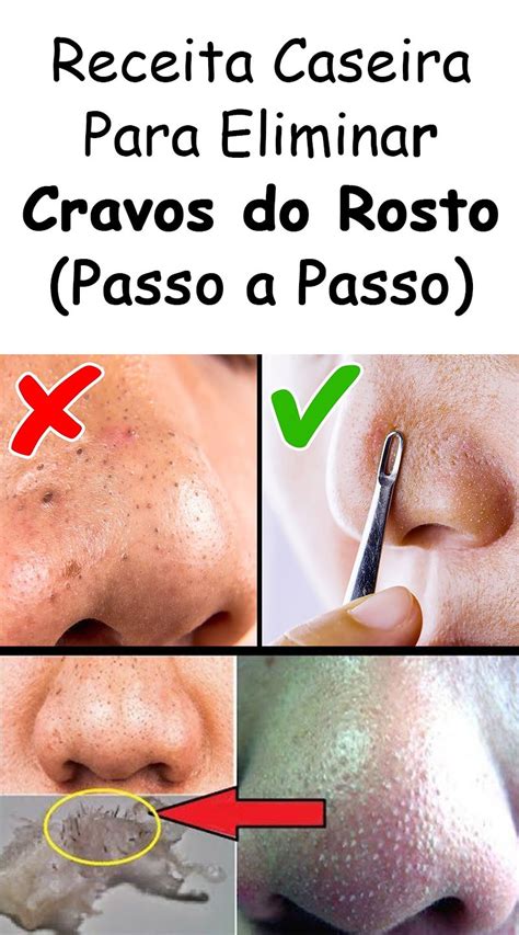 Dicas Caseiras Para Eliminar Cravos Do Rosto Passo A Passo