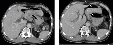 Figure 1 From Gastro Gastric And Gastro Duodenal Intussusception With Pancreatitis Due To Gist