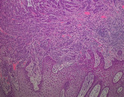 Moderately Differentiated Squamous Cell Carcinoma Of The Floor Of Oral