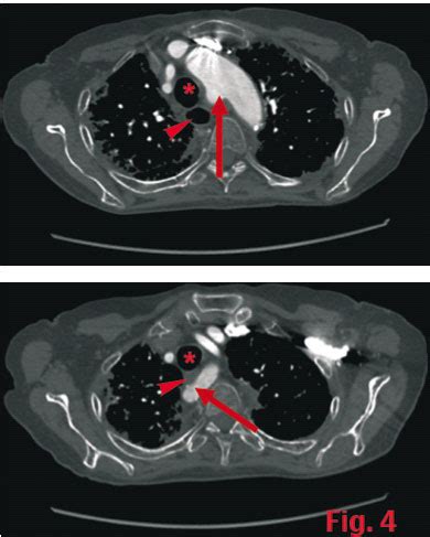 Arteria Subclavia Aberrante