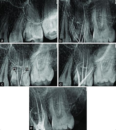 A B C D E Pre Op Of The Left Maxillary First Molar Working Download Scientific Diagram