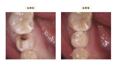 ジルコニアについて徹底解説！どんな症例がある？ 駒込の歯医者なら、きたはら駒込歯科｜jr駒込駅徒歩1分