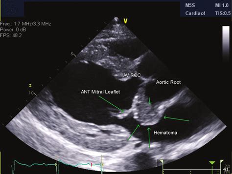 Transthoracic Echo Parasternal Long Axis View Showing Hematoma At Left Download Scientific