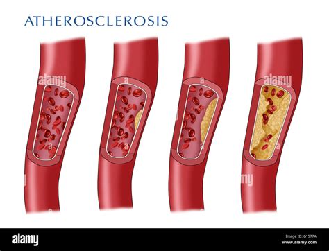 Illustration Depicting The Progression Of A Narrowed Artery Leading To