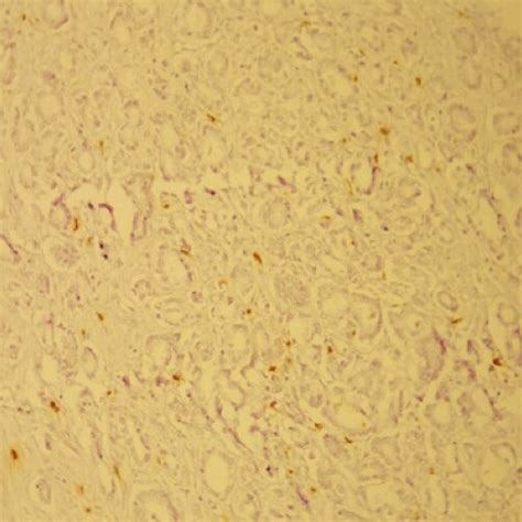 Mast Cell Tryptase (MC T ) ekspression in intratumoral area (x200 ...