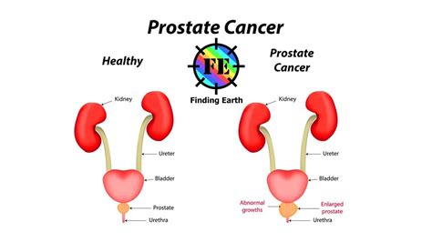 Prostate Cancer Diagram