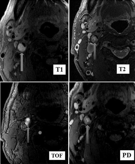 Figure 2 From Predictive Values Of Carotid High Resolution Magnetic