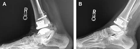 Outcomes Of Conversion Of Ankle Fusion To Total Ankle Arthroplasty