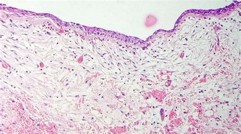 Dentigerous Cyst Histology