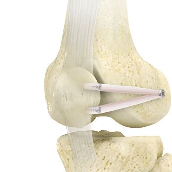 Medial Patellofemoral Ligament Reconstruction Monterey | Patellar Lateral Dislocation Salinas