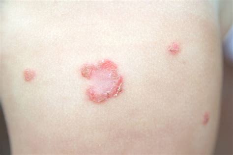O Que É Impetigo Na Pele - Impetigo: tudo o que você precisa saber