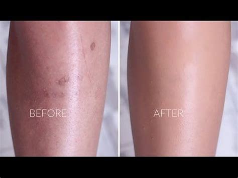 How I Cover Scarring Pigmentation Dark Spots On Legs Body