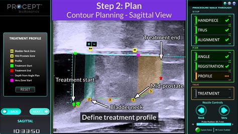 Aquablation Therapy With The AQUABEAM Robotic System For Lower