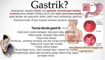 Gastrik Tanda Punca Dan Rawatannya Jelitawan Collections