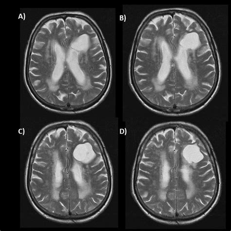 Brain Lesions Mri