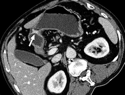 Three Dimensional Mdct For Preoperative Local Staging Of Gastric Cancer Using Gas And Water