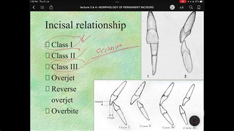 Lecture 4 Mandibular Central And Lateral Incisor Youtube