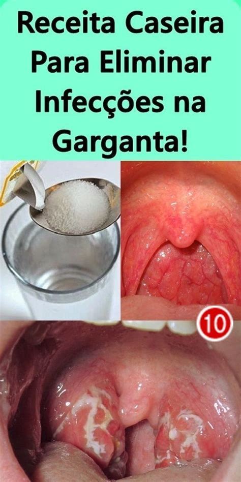 Garganta Inflamada E Olhos Remelando O Que Fazer - Receita Caseira Para Eliminar Infecções na Garganta! | Infecções de ...