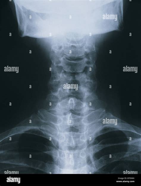 x-ray of bone Stock Photo - Alamy