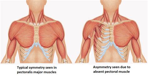 Poland Syndrome Presentation And Treatment Bone And Spine