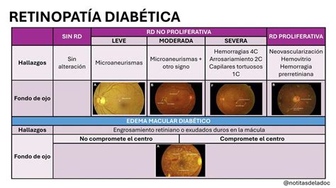 Clasificaci N De La Retinopat A Diab Tica Ladoc Udocz