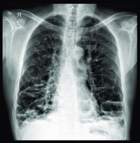 Posterior Anterior Chest Radiography Increased Lung Volume With Cystic