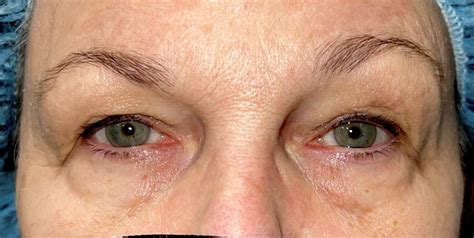 27 Eyelid Surgery Before And After Photos Dallas Plano Texas Cosmetic Reconstructive Eye Surgery