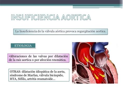 Estenosis Aortica E Insuficiencia Aortica