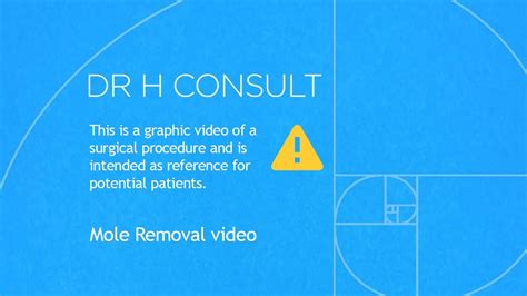 Laser Mole Removal Youtube