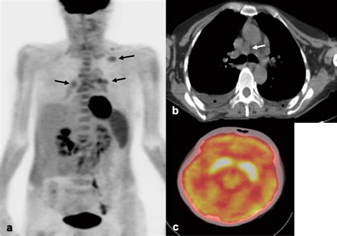 A Sixty Three Year Old Female With A History Of Sle And Rheumatoid Download Scientific Diagram